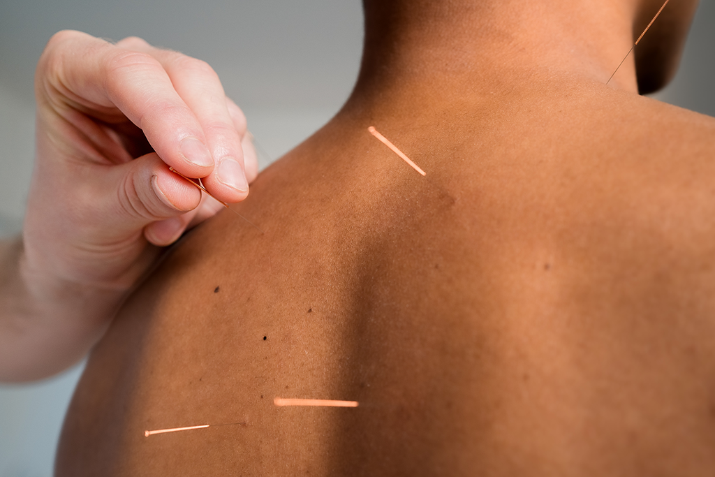Acupunctuur